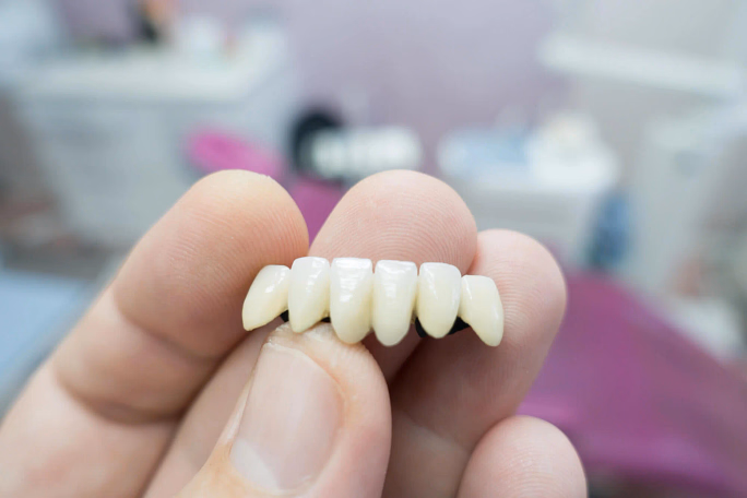 Close-up of hand holding a dental bridge with six artificial teeth against a blurred background.