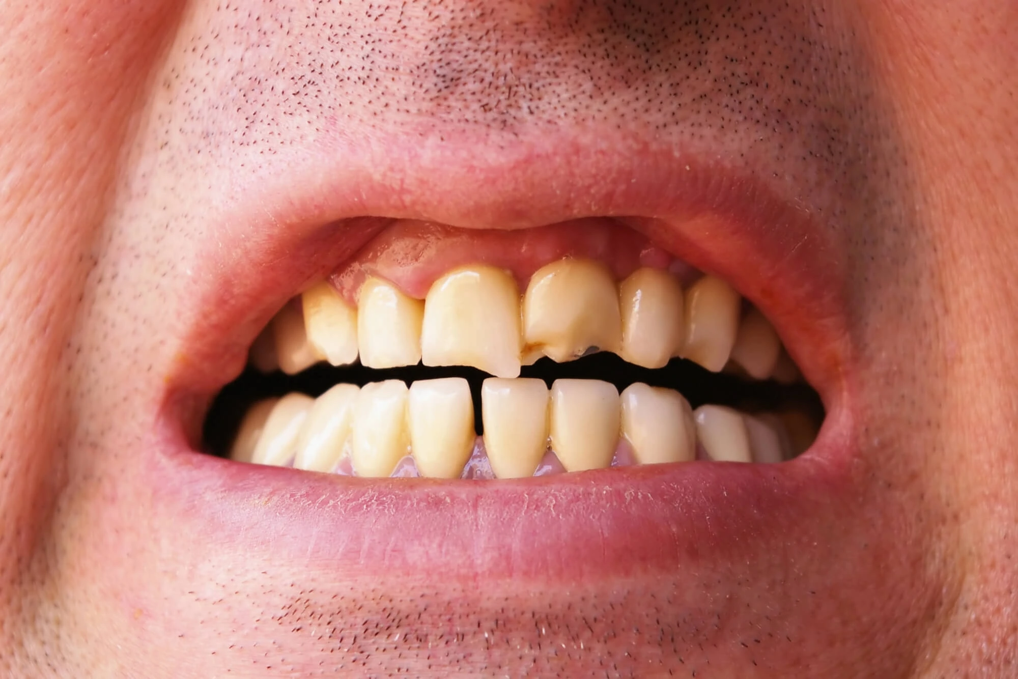Close-up of a mouth with a cracked and discolored upper front tooth among yellowish teeth.