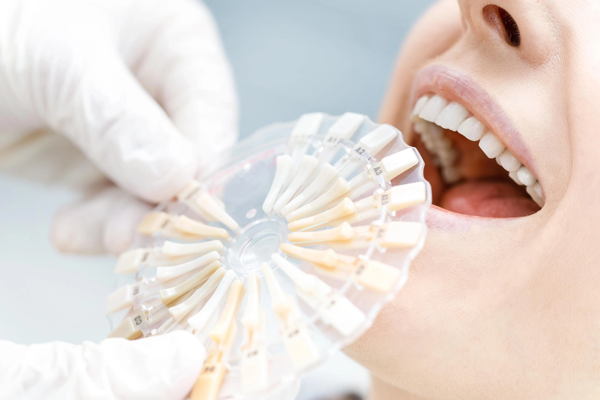 Dentist wearing gloves matching a dental shade guide to a patient's teeth during a dental checkup.
