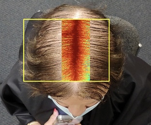 Hair Growth Treatment Honolulu - Wellness Center of Oahu