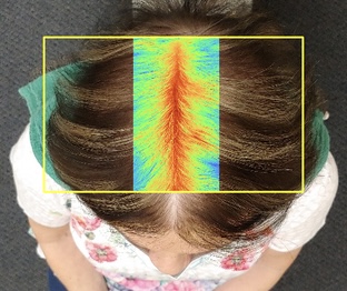 Hair Growth Treatment Honolulu - Wellness Center of Oahu