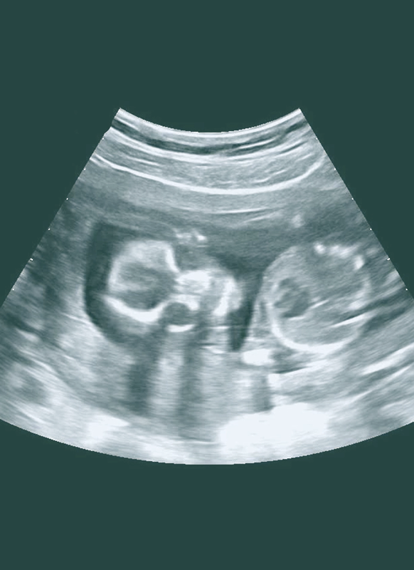 Ultrasound image showing two developing fetuses, indicating a twin pregnancy.
