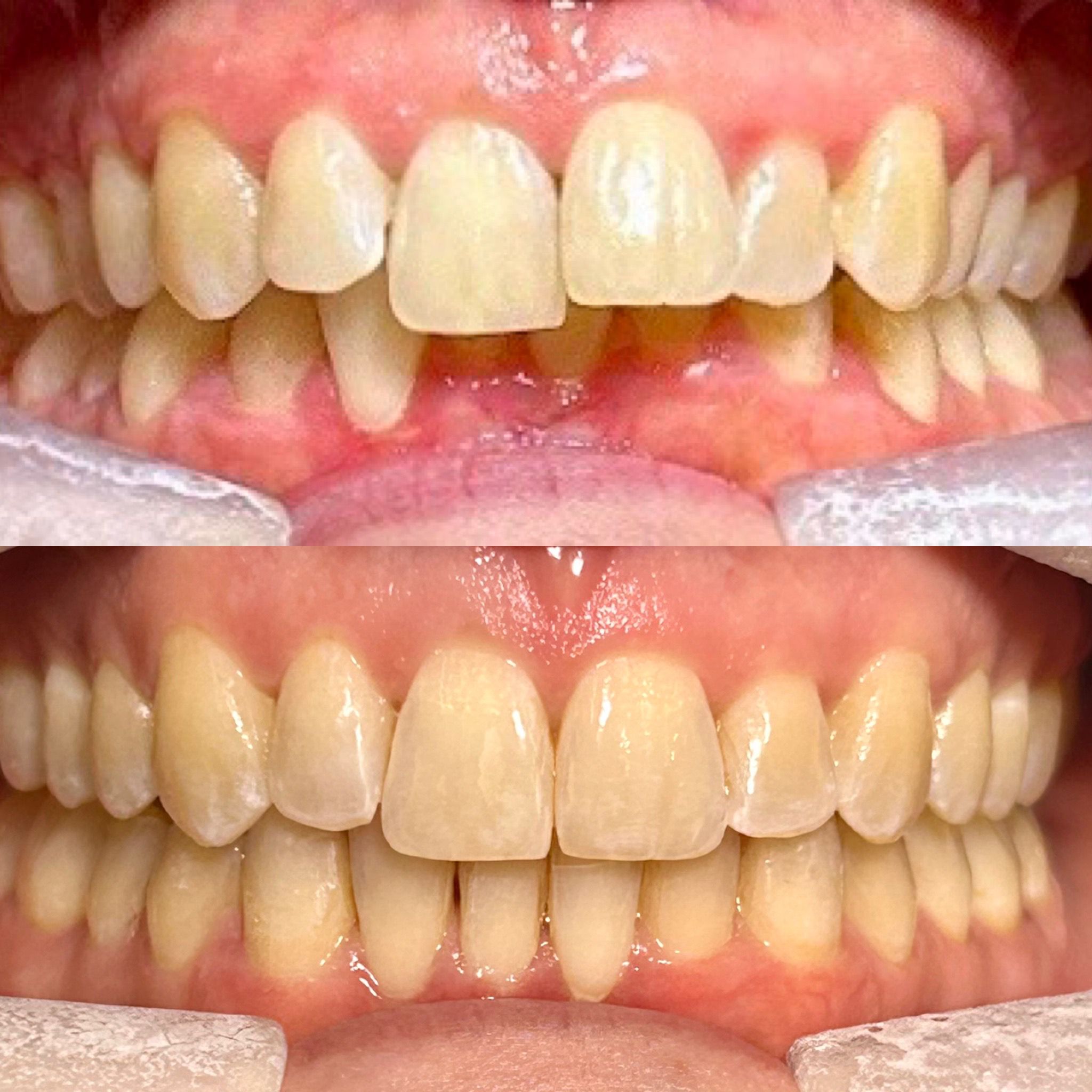 Close-up before-and-after images of a dental smile showing corrected alignment and improved spacing of teeth.