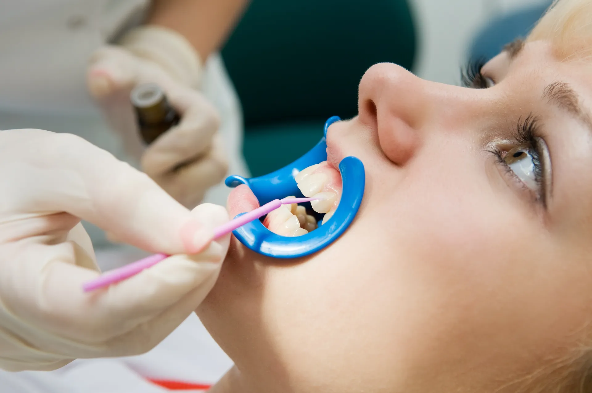 Dental professional applying sealant to child's tooth using a pink applicator and blue mouth retractor.