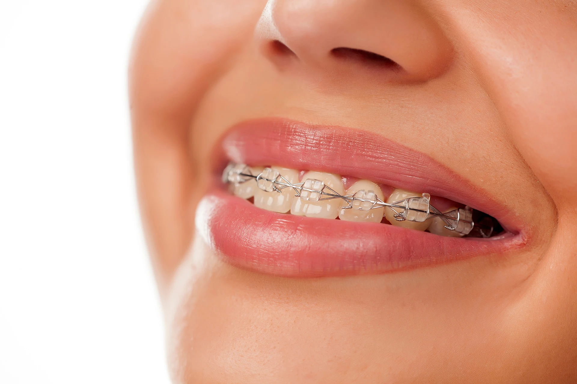 Braces in Yorkville, IL