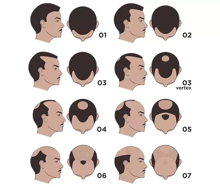 Norwood scale