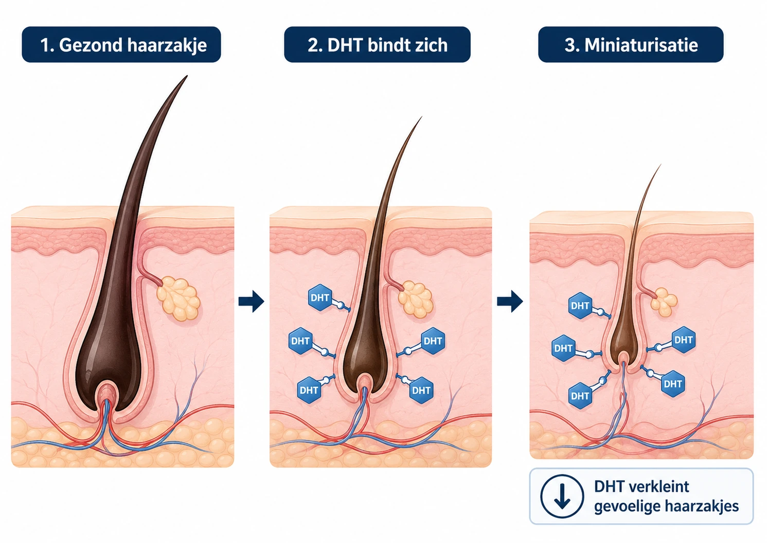 DHT: werking, haaruitval en hoe je het verlaagt