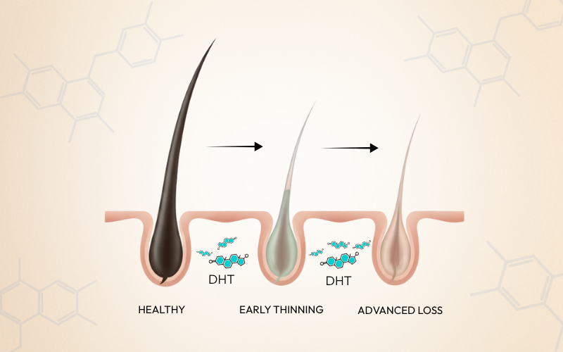 What is Dihydrotestosterone (DHT)? DHT and hair loss explained