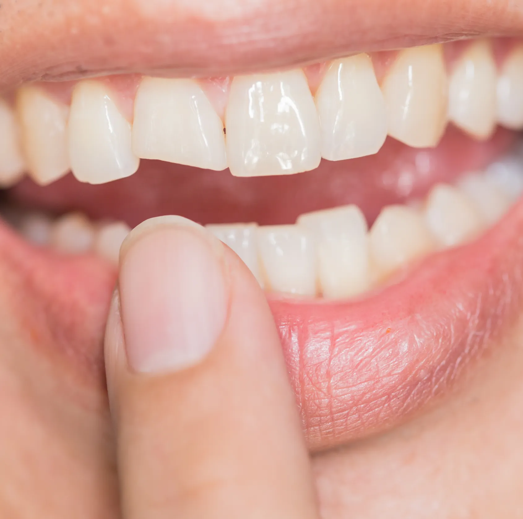 Mouth with chipped teeth