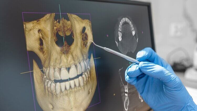 Computer-Guided Dental Implant Placement