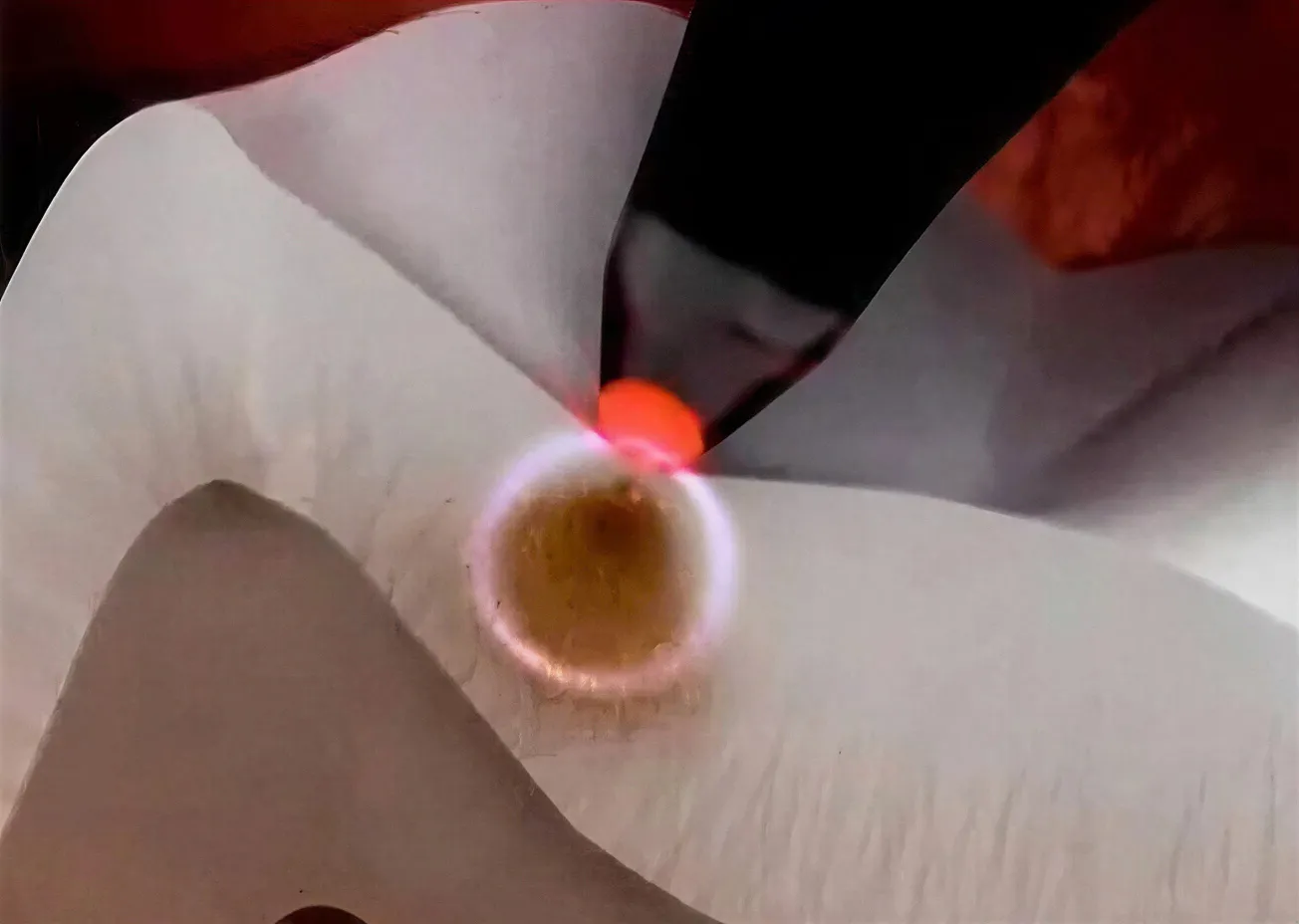 DIAGNOdent Laser Cavity Detection