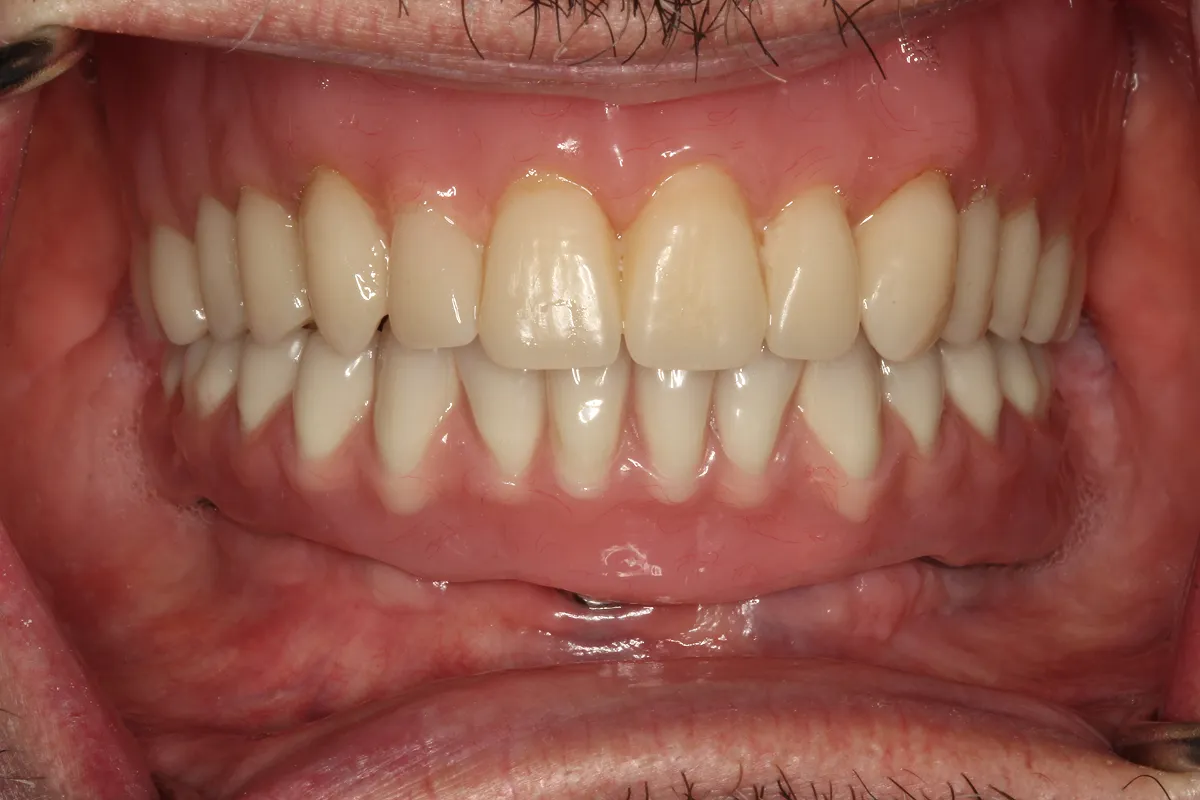 Beautiful custom esthetic dentures in New York, NY