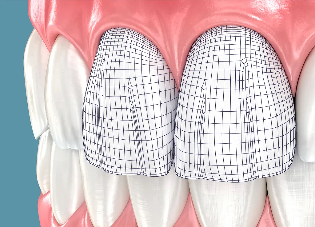 Before and after cosmetic dental bonding at Core Smiles NYC