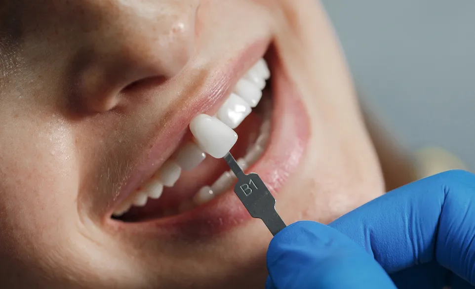 Close-up of a person smiling with a dental shade guide labeled B1 held near their teeth by a gloved hand.