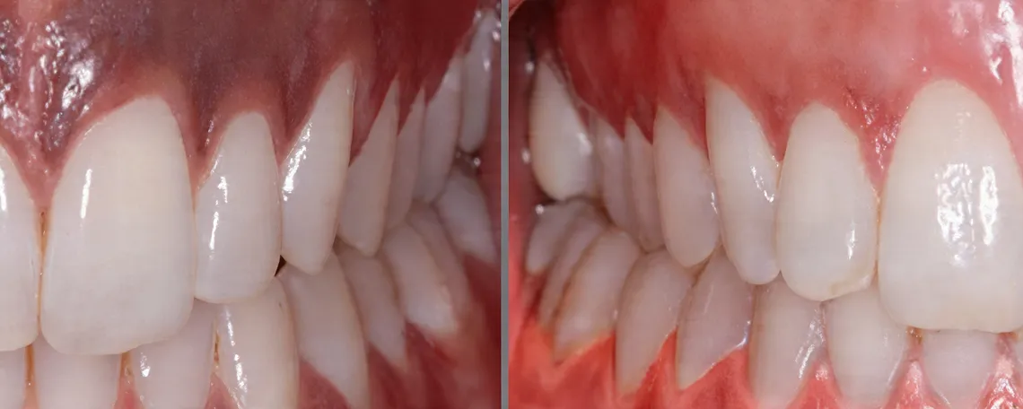 Close-up comparison of gums and teeth showing gum depigmentation with darker gums on the left and lighter, pink gums on the right.