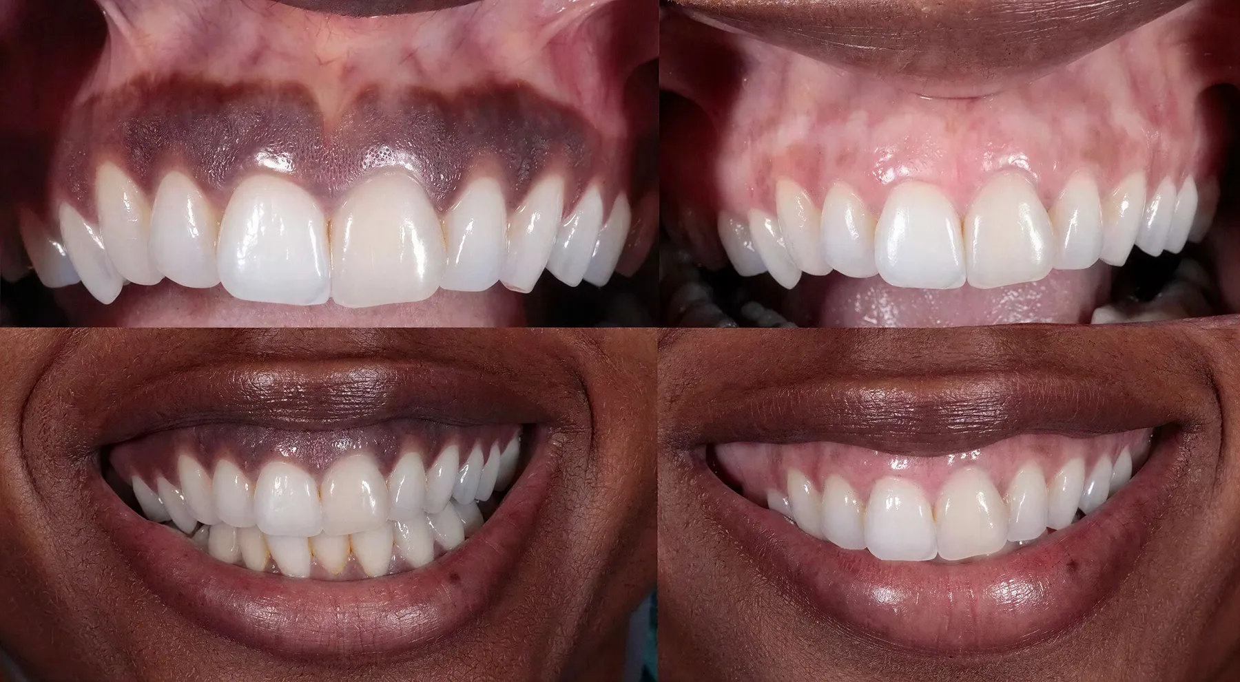 Before and after photos showing gum tissue depigmentation with darker pigmented gums in the before images and lighter, pink gums in the after images.