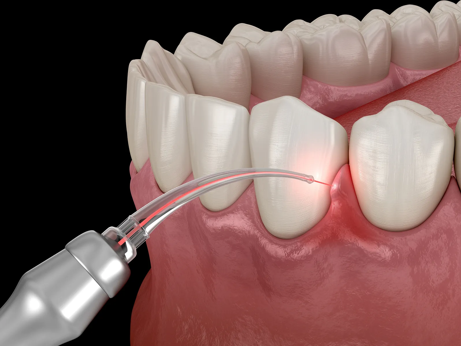 Close-up of laser gum correction surgery on gums between teeth.