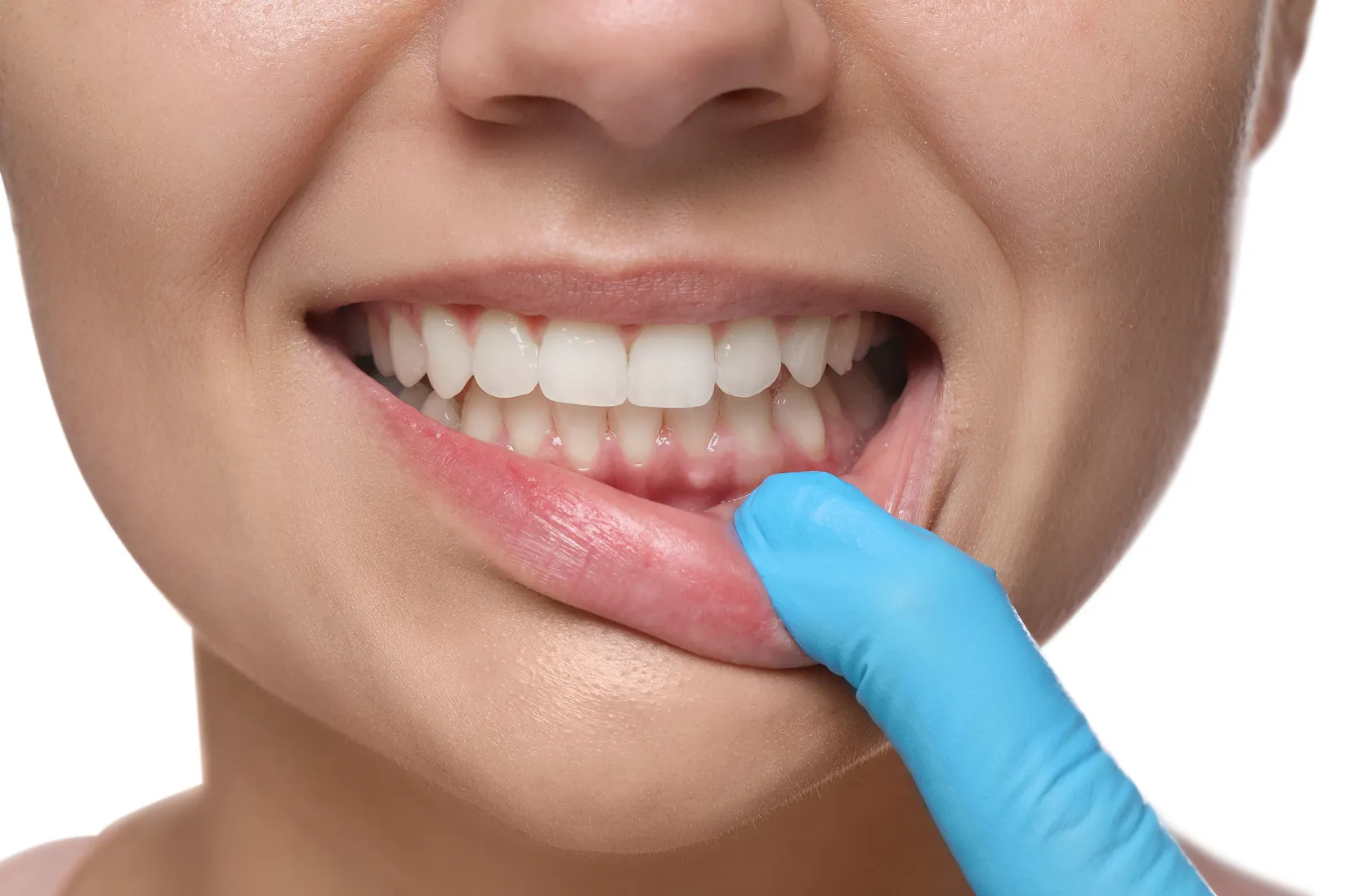 Person pulling down lower lip to show healthy gums and teeth with gloved finger.