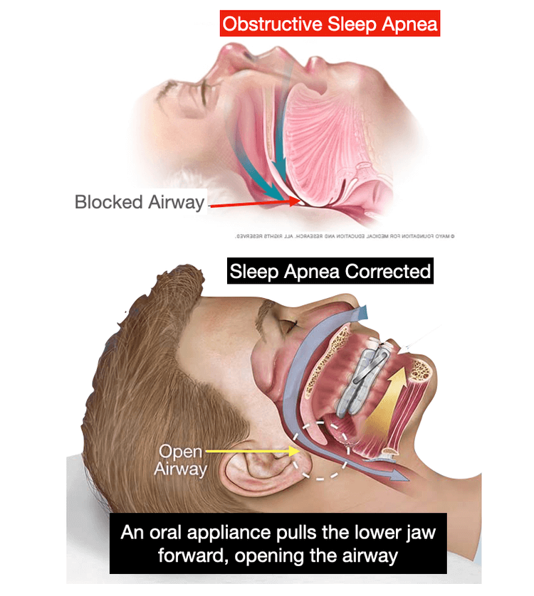 Side-by-side diagrams showing obstructive sleep apnea with blocked airway, and corrected sleep apnea with an oral appliance pulling the lower jaw forward to open the airway.