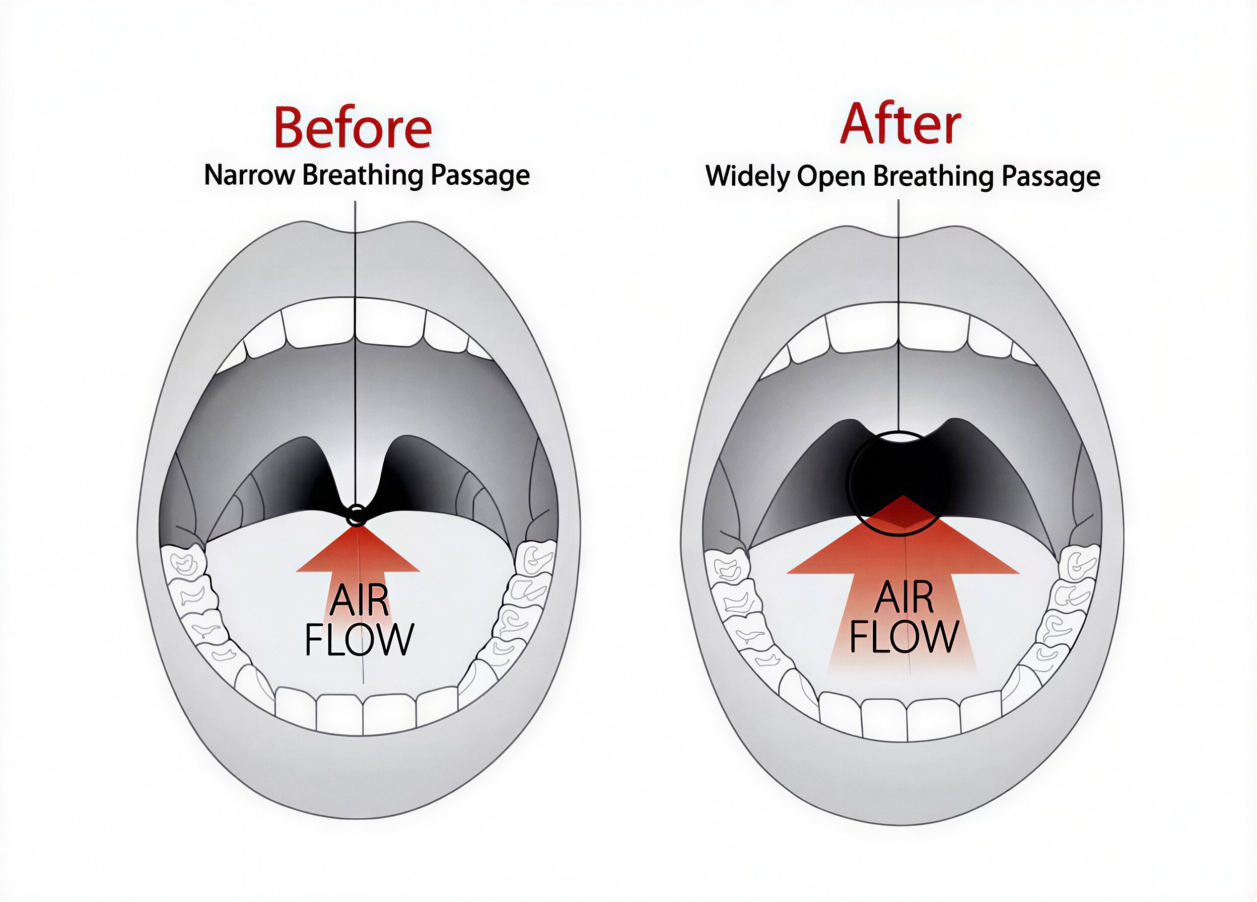 Diagram showing mouth open in two views: before with narrow breathing passage and restricted airflow, and after with widely open breathing passage and increased airflow.