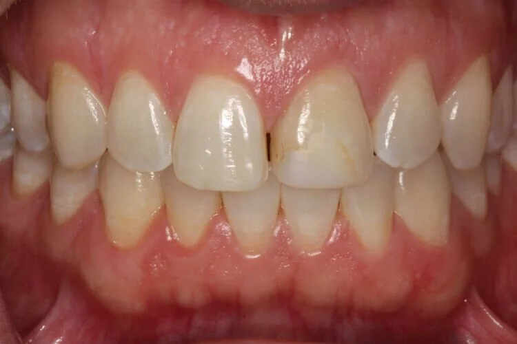 Cosmetic dental bonding consultation at Core Smiles NYC