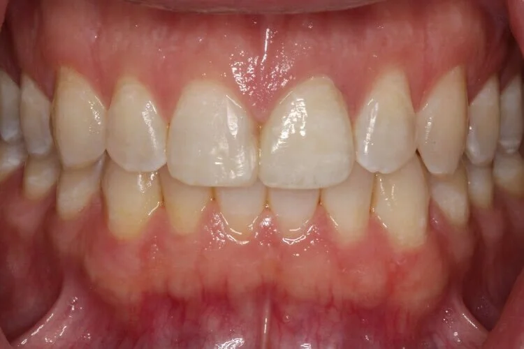 Cosmetic dental bonding consultation at Core Smiles NYC