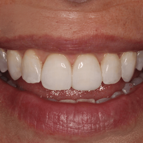 Composite Bonding overview