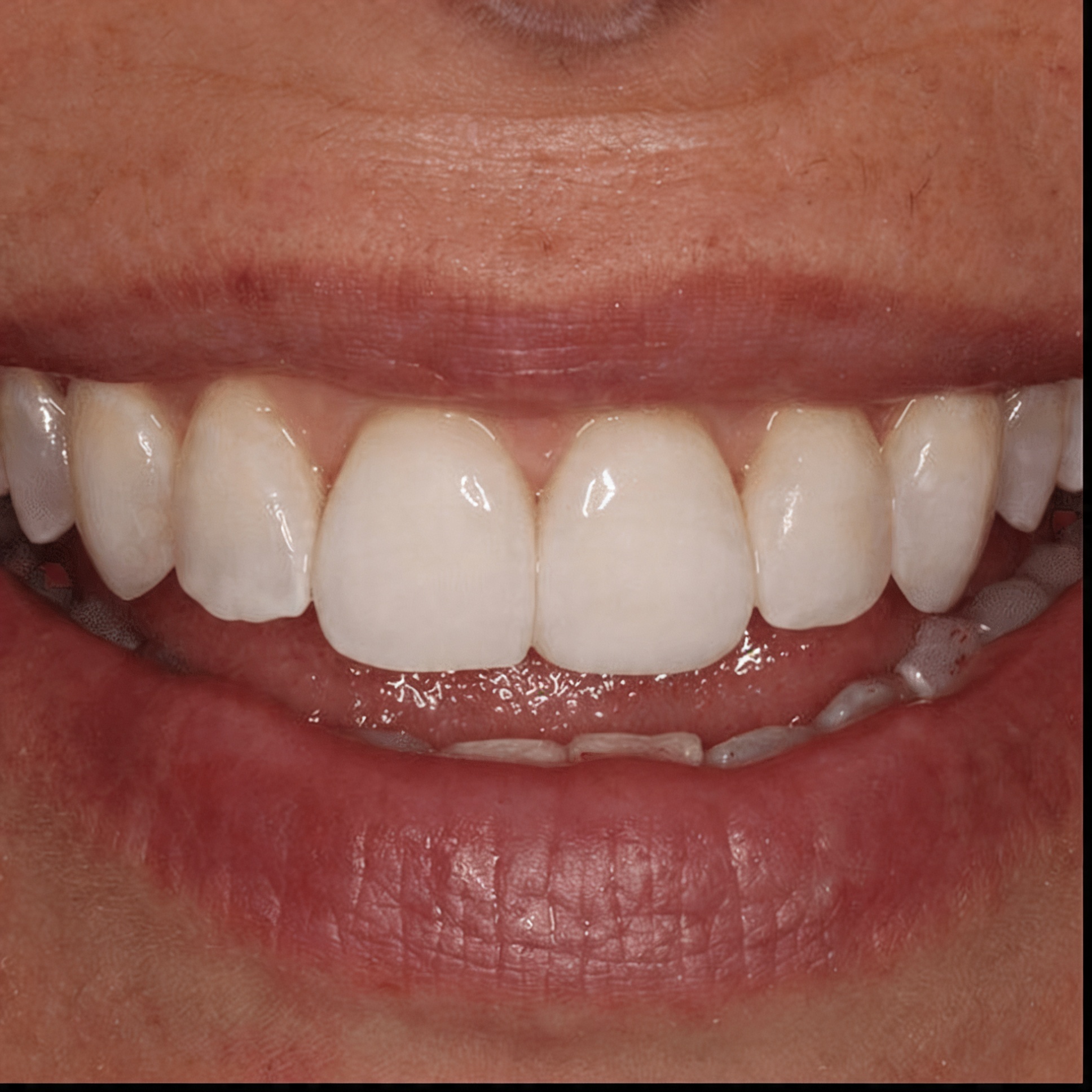 Cosmetic dental treatment options