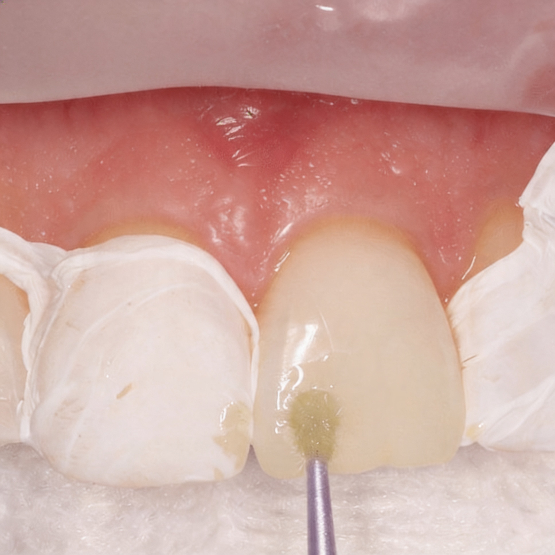 Isolate etch and apply adhesive