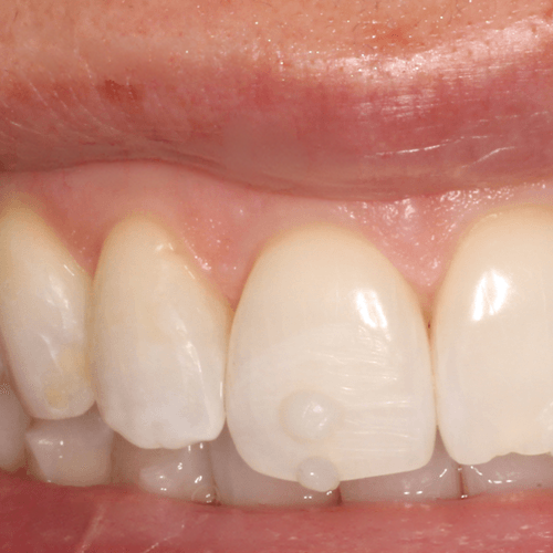 Shade mapping for composite resin