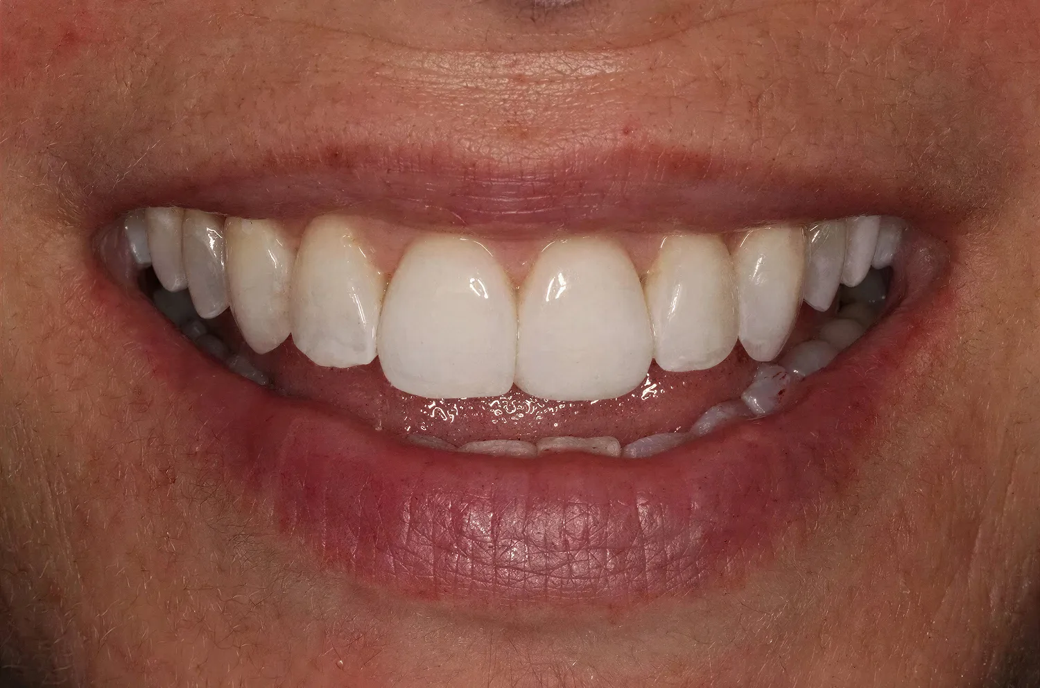 Cosmetic dental bonding consultation at Core Smiles NYC