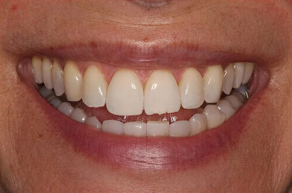 Cosmetic dental bonding consultation at Core Smiles NYC