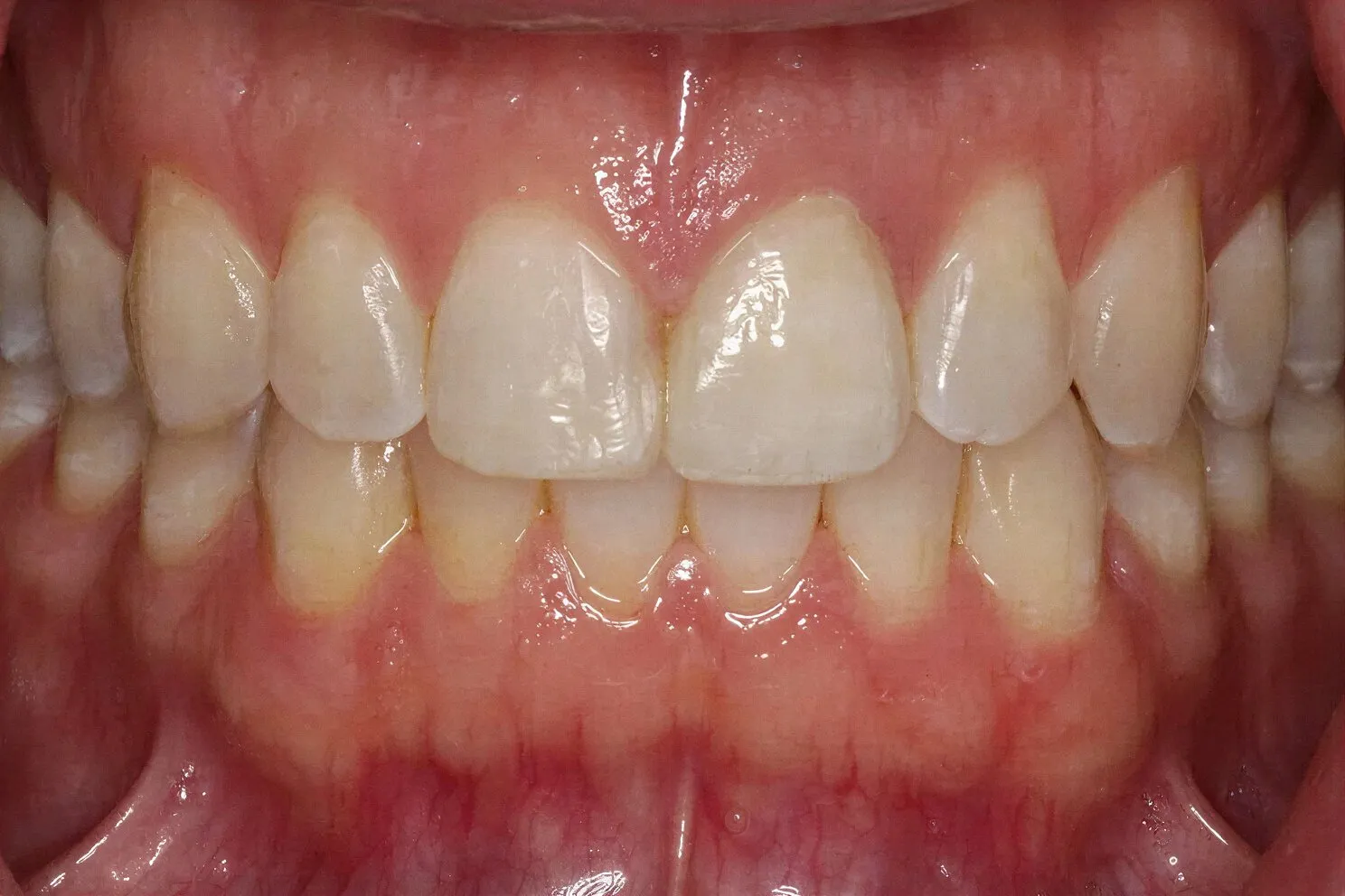Cosmetic dental bonding consultation at Core Smiles NYC