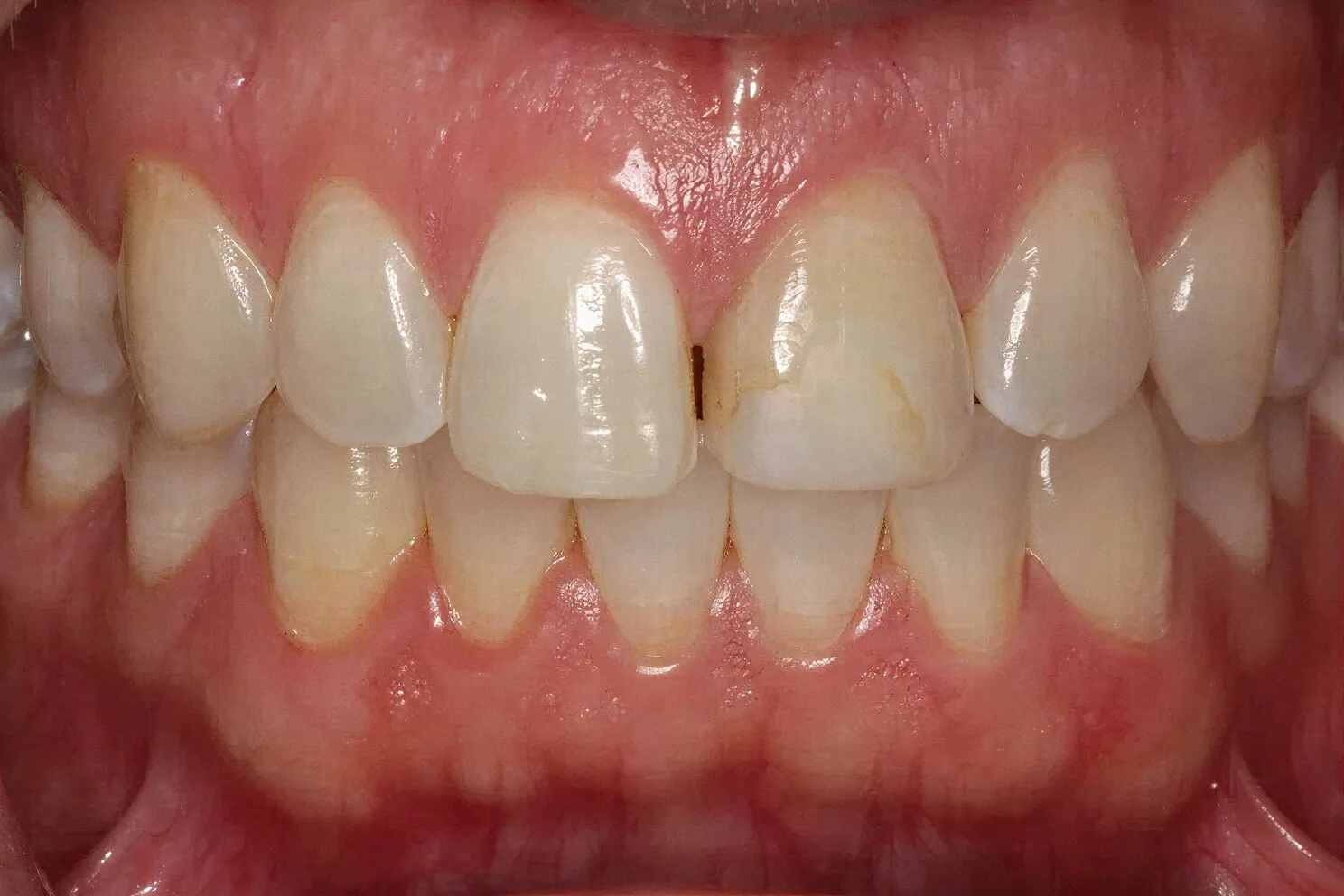 Cosmetic dental bonding consultation at Core Smiles NYC