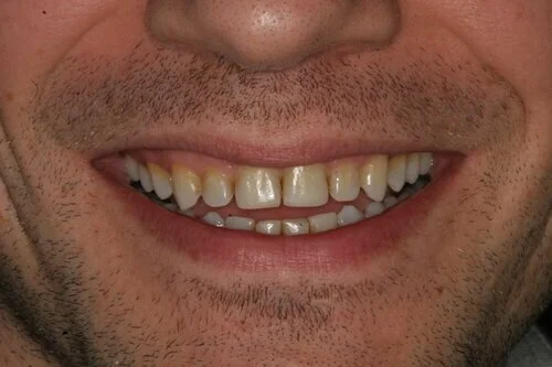 Jack before porcelain veneers