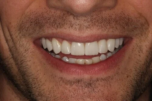 Jack after porcelain veneers