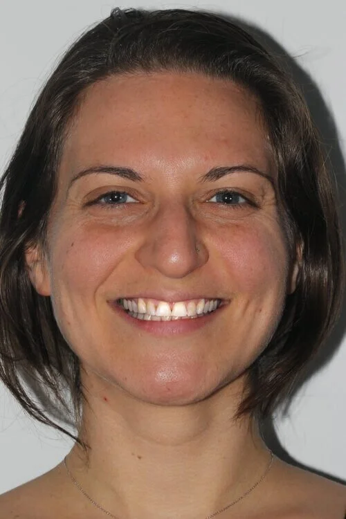 Aliya before porcelain veneers treatment