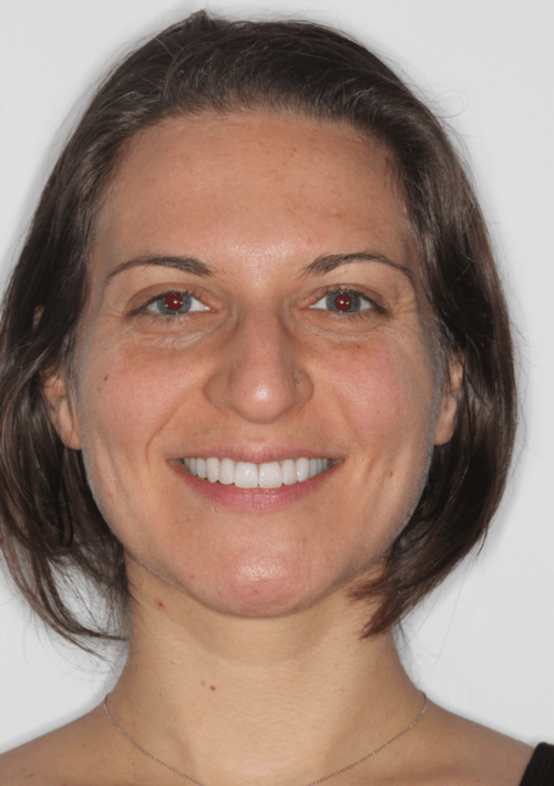 Aliya after porcelain veneers treatment