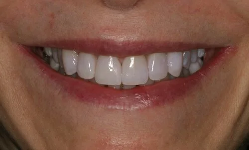 Patient after veneers
