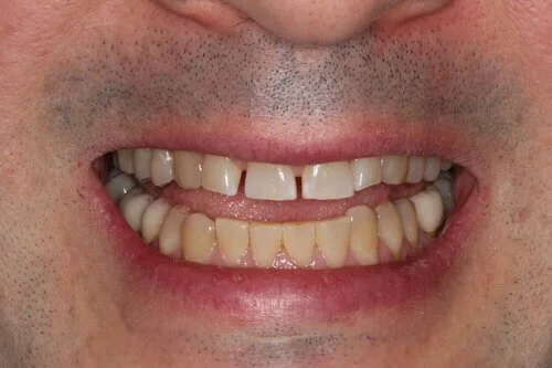 Patient before veneers