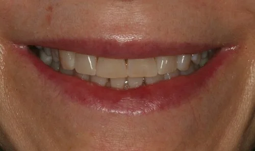 Patient before veneers