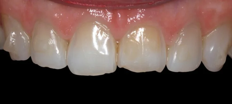 Patient before veneers