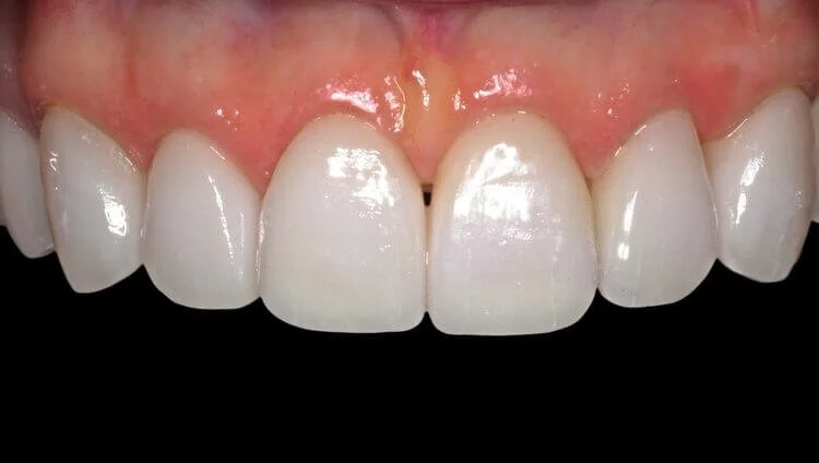 Patient after veneers