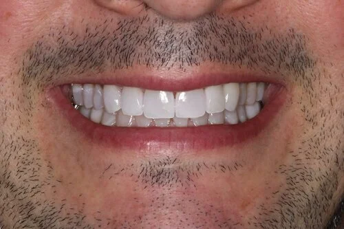 Patient after veneers