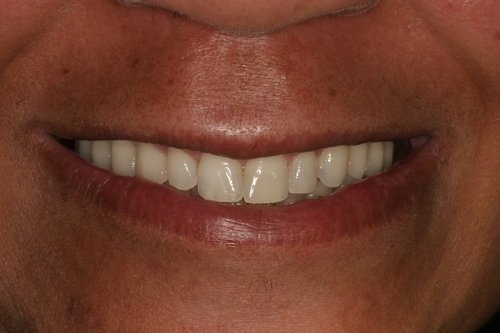 Patient after dental implants
