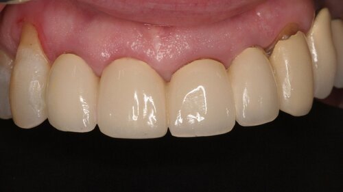 Patient before implant bridge