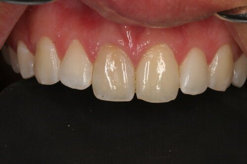 Patient before veneers