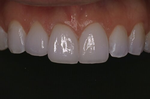 Patient after veneers