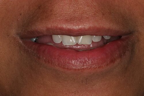 Patient before dental implants