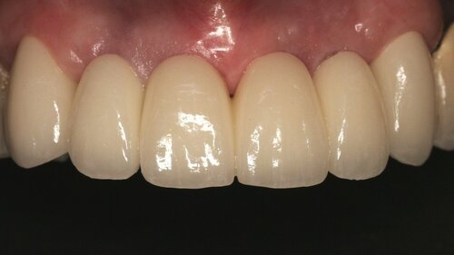 Patient after implant bridge